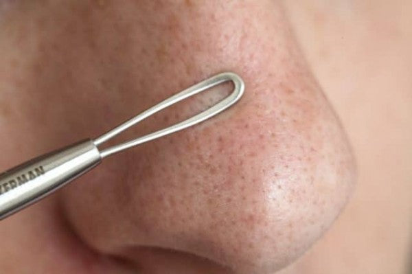 Siyah Nokta Nedir? Neden Olur, Nasıl Geçer?