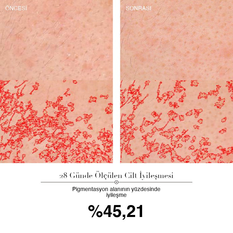 SkinLift Pro 28 günlük ölçüm: pigmentasyon alanının yüzdesinde %45,21 iyileşme — öncesi ve sonrası