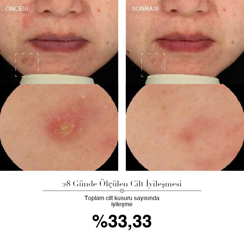 SkinLift Pro 28 günlük ölçüm: toplam cilt kusuru sayısında %33,33 iyileşme — öncesi ve sonrası